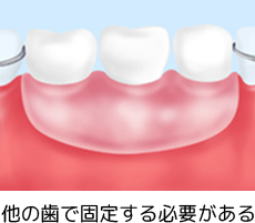 他の歯で固定する必要がある