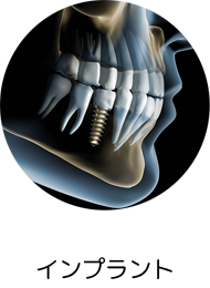 インプラント