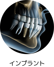 インプラント